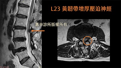 骨盆疼痛的診斷與治療：案例分析與專業建議