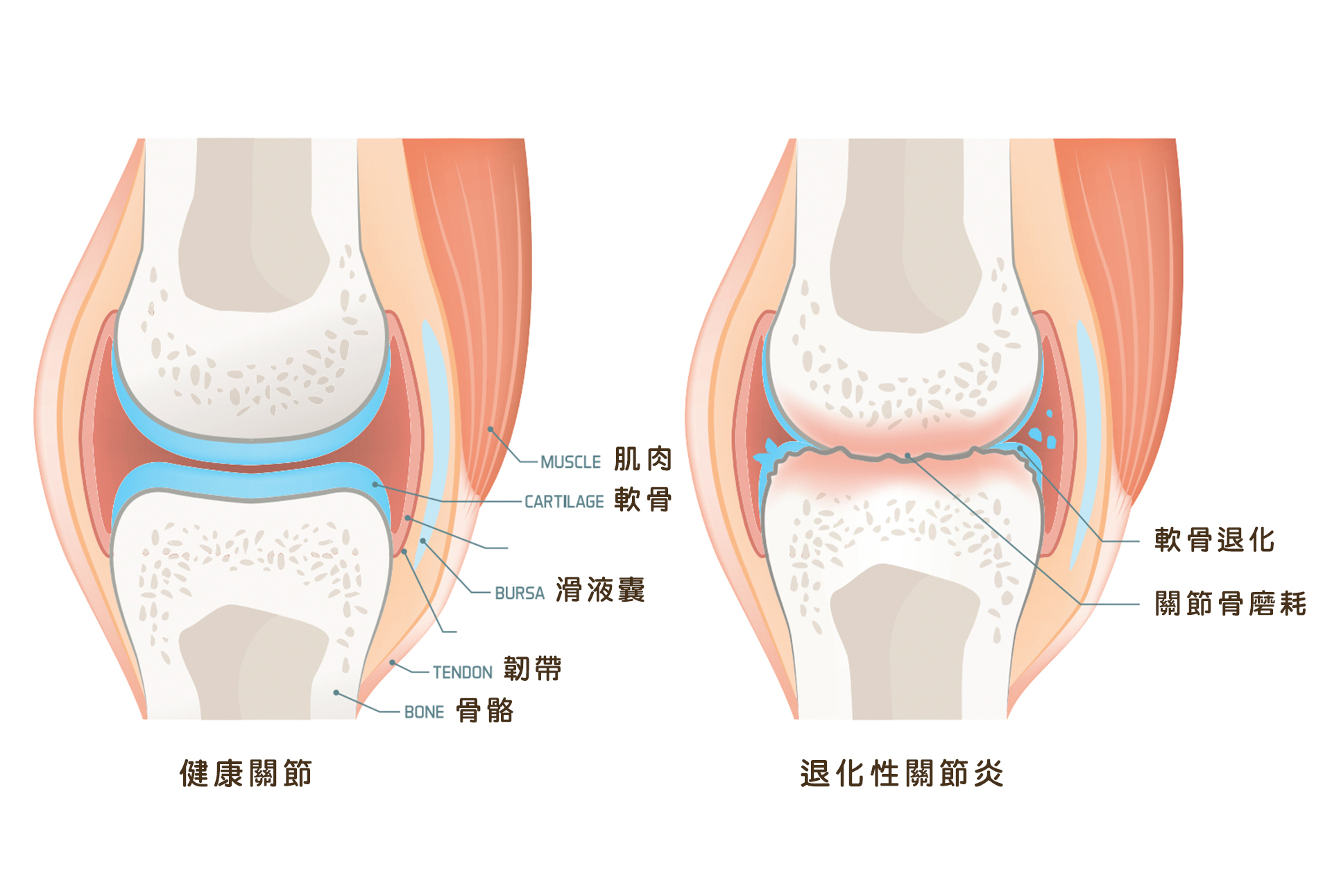 軟骨治療