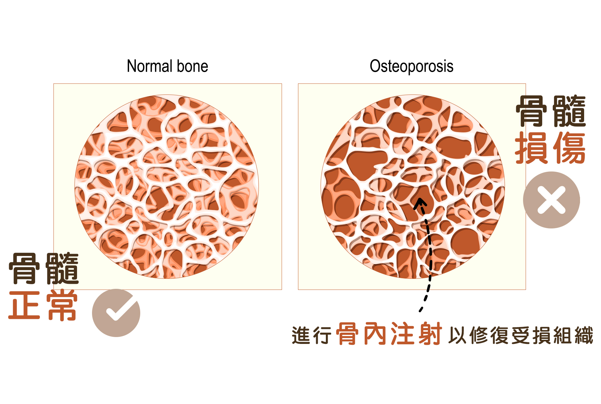 什麼是「骨內注射」？ 關節治療的最後一塊拼圖