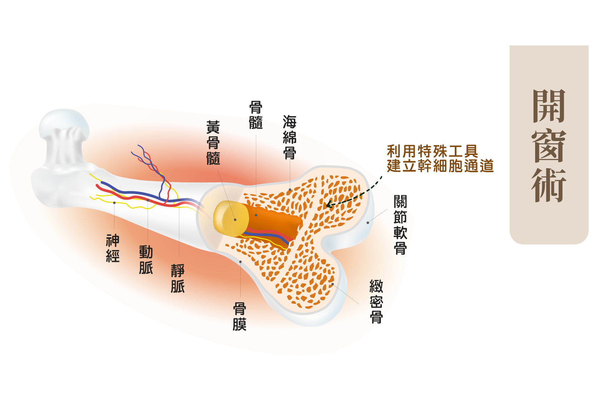 開窗術-你所不知道的軟骨磨損