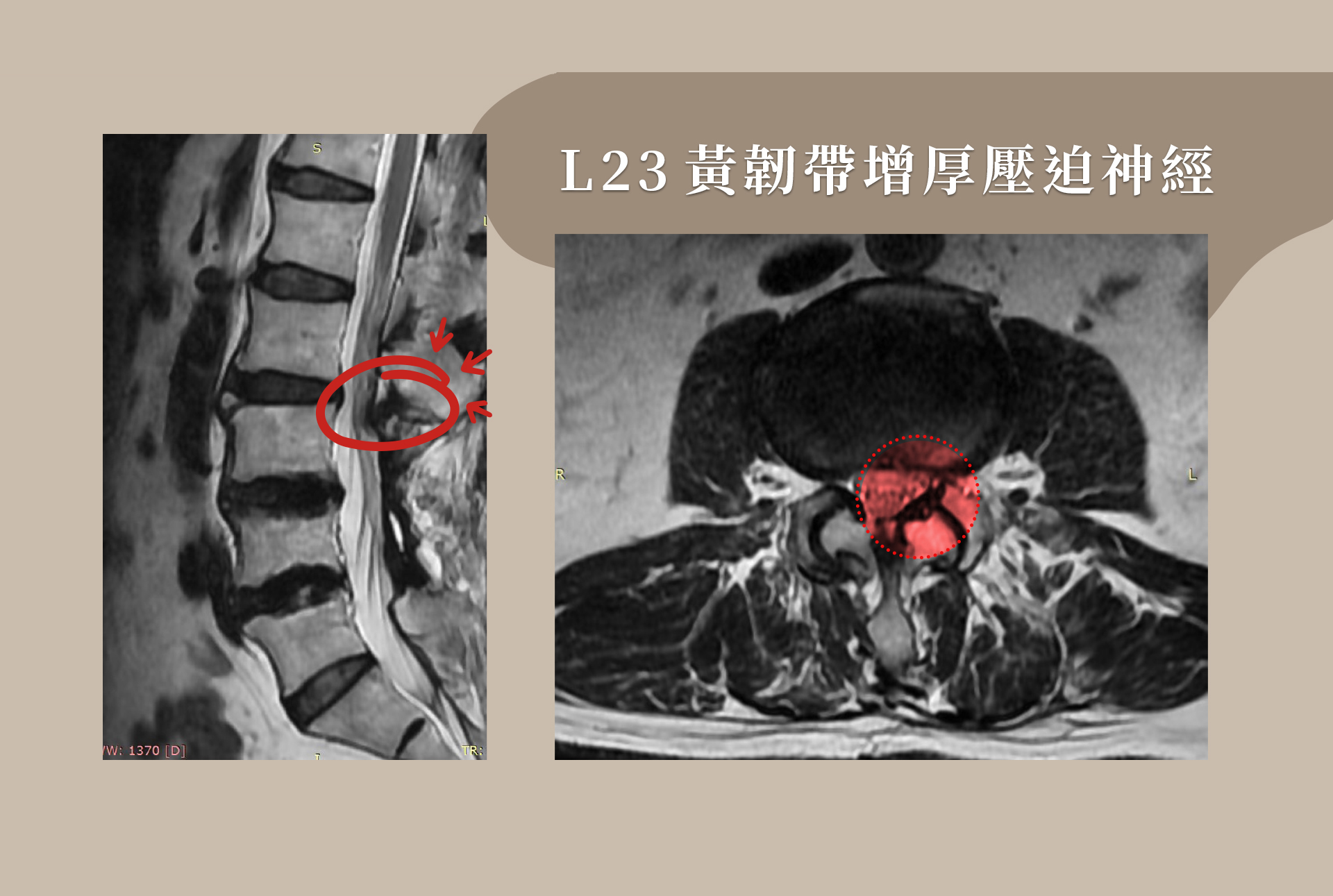 什麼是消融術？