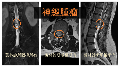 罕見原因！脊椎腫瘤引發的椎管狹窄——別讓下背痛拖累你的生活